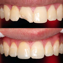 Resina Foto Esmalte E Dentina Llis - Fgm Cor Da1